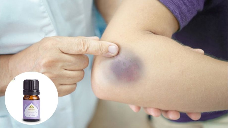 Thoa Tinh dầu hoa Oải hương làm lành các vết thâm tím, vết bầm