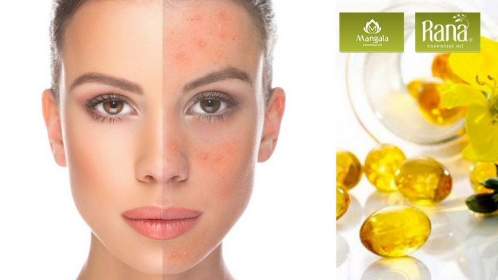 Tinh Dầu Gừng Gió có hoạt tính chống oxy hóa cao, dùng để chống lão hóa, hứa hẹn chống nếp nhăn hiệu quả.